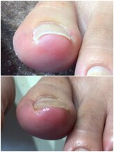 モアクリスタル(More Crystal)/巻き爪補正