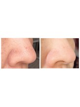 スワンスタイル(SWANSTYLE)/【毛穴スッキリコース】