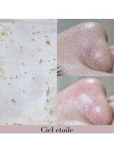 シエルエトワレ/毛穴エクストラクション