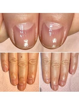 ココデネイル(cocode nail)/悩み:爪が割れる…(50代前半)