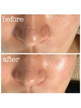 彩ビューティーラボ(彩 Beauty Labo)/ハーブピーリング