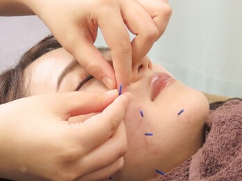 本多鍼灸整骨院の写真/【鍼灸歴20年以上の国家資格者が施術★】美容鍼で顔全体の筋肉をゆるませ血の巡りをよくしリフトアップ♪