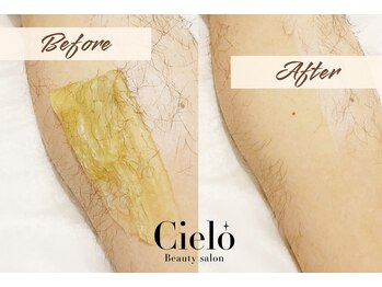 シエロ 赤坂店(Cielo)/部分脱毛も可能