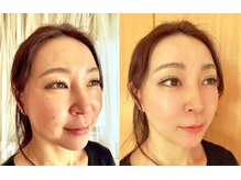 オリノ(Olino)/シワ改善!!『リジュラン導入』