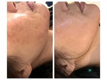 肌質改善専門【Salon da Mahina】毛穴ケア/ニキビケア/ハーブピーリング/シミケア/ハーブピーリング/藤沢