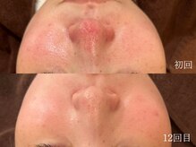 ウォーム(warm)/毛穴/毛穴洗浄/毛穴ケア/毛穴