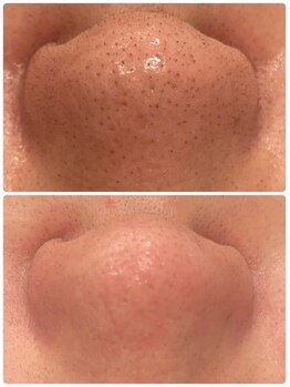 リジュベネ(rejuvena)/毛穴洗浄で黒ずみナシへ♪