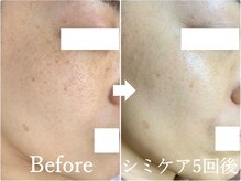 ニコ アンド キャンディー(Nico.&Candy)/本気でシミ改善したい方募集中