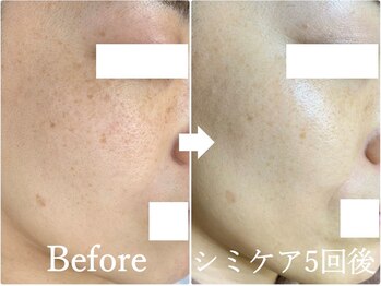 ニコ アンド キャンディー(Nico.&Candy)/本気でシミ改善したい方募集中