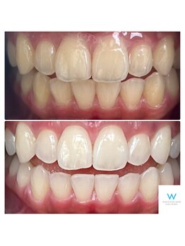 ホワイトニングショップ 奈良生駒店/メンテナンスの大切さ