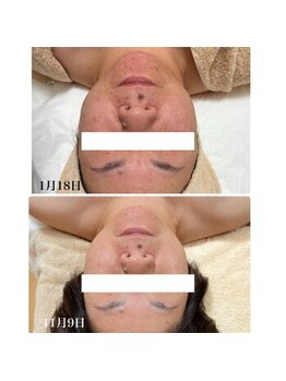 キーオブフェイス(Key of Face)/1年でまるっとキレイになった♪