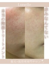 ルネル(Lunelle)/ファンデで赤みはもう隠さない！