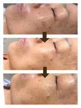 エアリアル 玉名店/頑固なシミにアプローチ！