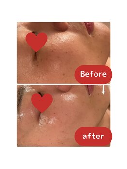 ティンクルホワイト 上尾店/ハーブピーリング施術後