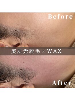 エピナ 横浜店(Epina)/フェイシャル脱毛/顔WAX脱毛