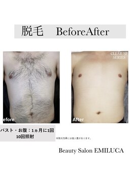 エミルカ(EMILUCA)/メンズ全身脱毛