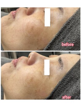 サロンドティアラ(Salon de Tiara)/フォト＋部分メソ＋スポット