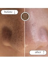 エステティック らぽーる(Rapport)/毛穴の黒ずみ・ざらつき解消