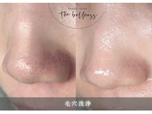 ザ ベルネス(The bellness)の雰囲気（毛穴のお悩みは当店へ◎毛による黒ずみも解決♪）