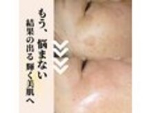 プログレス(progress)の雰囲気（4ヶ月のホームケアでシミ改善しませんか？）