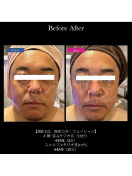 メンズエフディ ファウンデーション(メンズFD)/スカルプケア＋EMS