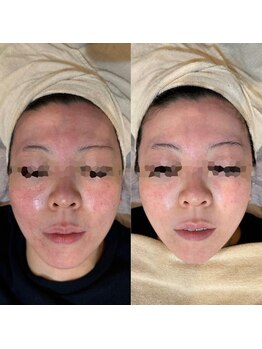 リボディ プラチナ(Rebody platinum)/小顔リフェイスコラーゲンリフト