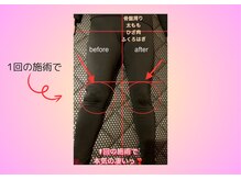 ヨサパーク ハーブ Melody亀山店(YOSA PARK)/2分間リンパマッサージ（痩身）