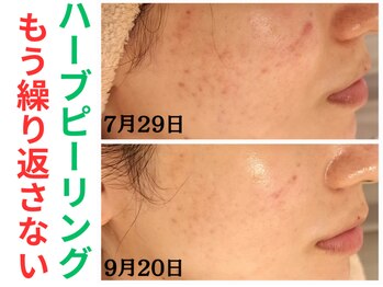 エリン(ERIN)/毛穴徹底洗浄×ハーブピーリング