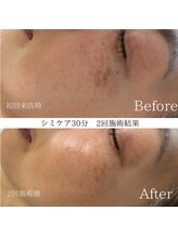 リフィール(Re:feel)/シミケア３０分２回施術