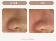 サロンドベル(Salon de BELLE)/ビフォー＆アフター（毛穴洗浄）