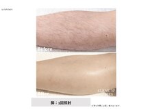 リネ(Rine)/before→after