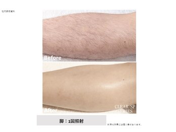 リネ(Rine)/before→after