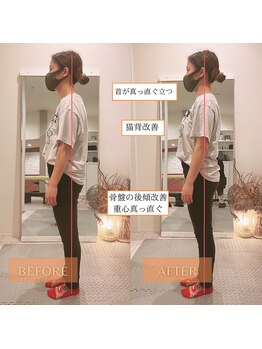 サンテリア(Santelia)/猫背と太ももの張り