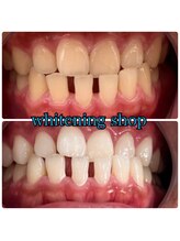 ホワイトニングショップ 豊橋店(WHITENING SHOP)/口元を隠さず笑えるようになる