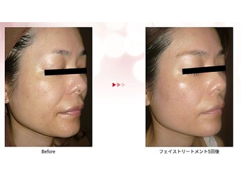 フェムプリュ(femplus)/エンダモロジー最新型!