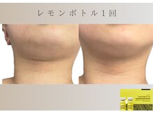 フロックス(Phlox)/小顔脂肪分解　レモンボトル