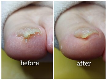 【足爪の陥入爪】