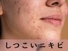 【肌荒れ】繰り返すしつこいニキビ 根本改善 美肌フェイシャル(デコルテ込)