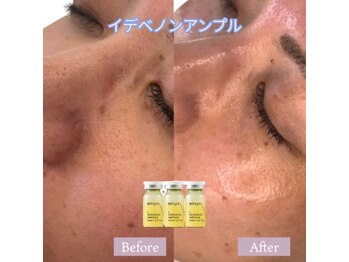 ソアン(Soin)/肌悩み別韓国水光生美容液