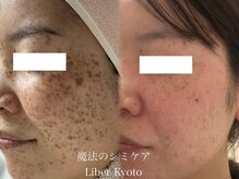 エステティック リベル キョウト 京都駅前店(Esthetic Liber Kyoto)/魔法のシミケア