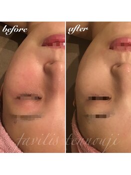 ファビリス 天王寺店(FAVILIS)/ACトリートメント3回/20代