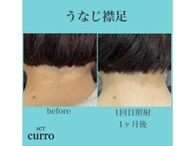 アクト クロ(ACT curro)/【うなじ襟足】脱毛施術例