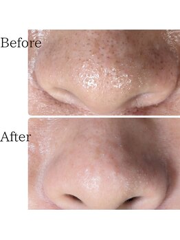 セルノヴァ(Cell Nova)/毛穴洗浄/フェイシャル/毛穴ケア