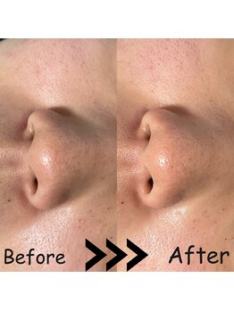 ゆしんアネックス/全顔毛穴洗浄ビフォーアフター！