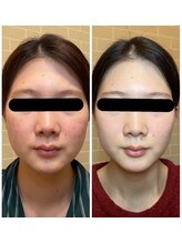 エステサロン 美飾り イオンモール木更津店/before⇒after/ハーブピーリング