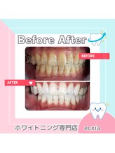 エクシアホワイトニング 札幌中島公園店/Before After［ホワイトニング］
