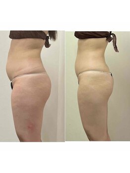 ラディアボディ四十瀬/美容痩身機器＋痩身リンパ