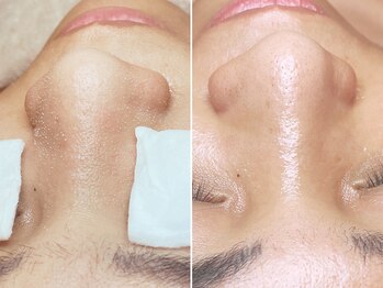 エングラッシー(en glassy)の写真/【速攻実感/毛穴レス】感動体験×続けるほど美肌が進化！毛穴レス艶肌♪結果重視の集中ケア