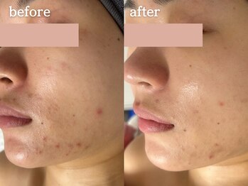 メルシア(merucia)/跡、ニキビケア、赤み改善