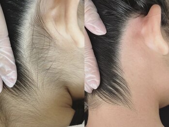 ソラナ(sorana)の写真/うなじWAX脱毛＋光脱毛で速攻で綺麗になれる！自分で見えないうなじ・背中をWAXと光のダブルでつるつるに♪